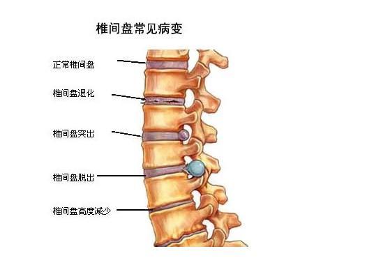 互动交流 聂家传人解答  腰椎间盘突出症是较为常见的疾患之一,主要是