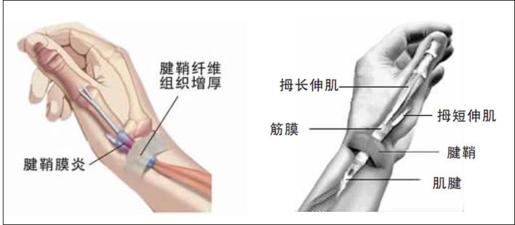 腱鞘炎